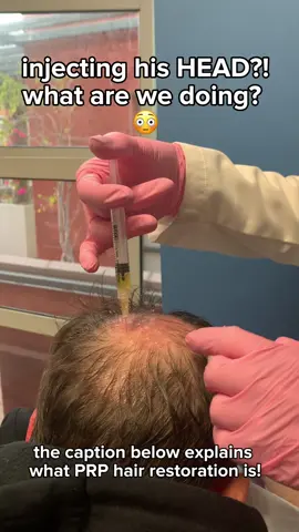 💉✨ PRP Scalp Injections: Harnessing Your Body’s Own Healing Power for Hair Restoration Today, we performed PRP (Platelet-Rich Plasma) therapy for hair restoration — a non-surgical, minimally invasive treatment designed to stimulate natural hair growth and improve hair density. PRP is derived from a small sample of the patient’s own blood. After spinning it in a centrifuge, we extract the platelet-rich plasma — a concentration packed with growth factors that play a crucial role in tissue regeneration and healing. Once injected into targeted areas of the scalp, PRP works to: ✔️ Stimulate dormant hair follicles ✔️ Increase blood supply to the scalp ✔️ Strengthen existing hair ✔️ Promote natural, gradual hair regrowth This treatment is ideal for early-stage hair thinning or as a complementary therapy alongside other hair restoration treatments. Because it uses your own plasma, the risk of allergic reaction or rejection is extremely low. Results vary, but most patients begin to notice improvements in texture, thickness, and shedding after a few sessions spaced 4–6 weeks apart. Whether you're just starting to notice thinning or looking for a natural solution to enhance your hair restoration journey, PRP may be a great option. 📍Inquire today to see if you’re a candidate at bevhills.com