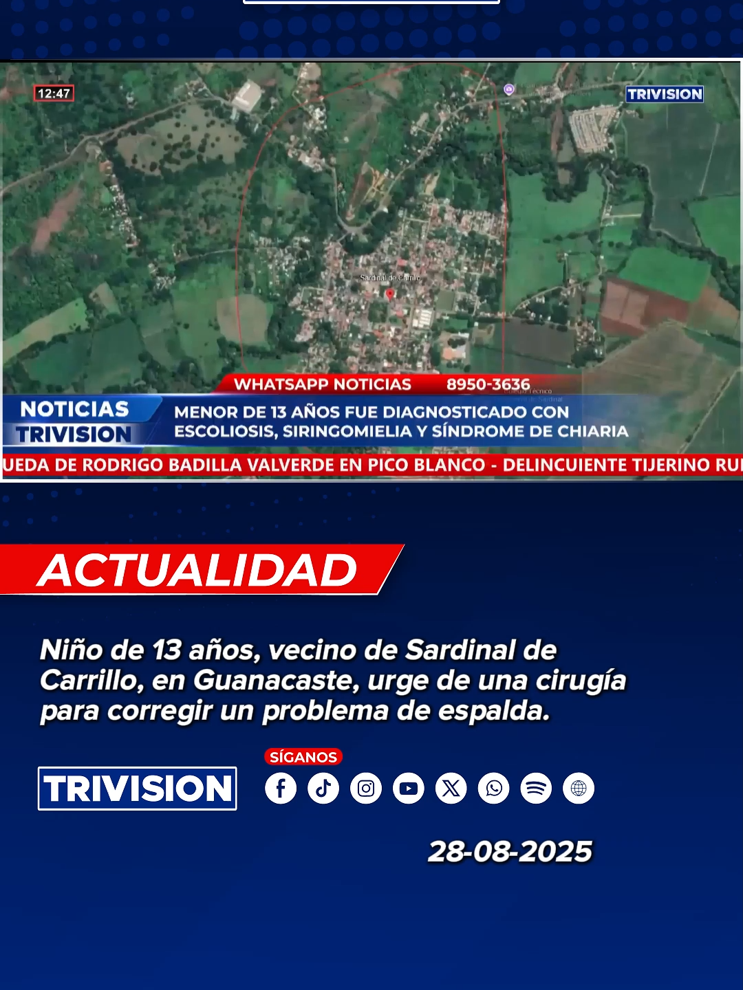🔴 #NoticiasTrivision | Niño de 13 años, vecino de Sardinal de Carrillo, en Guanacaste, urge de una cirugía para corregir un problema de espalda.
