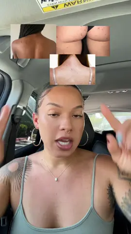 A ride or die in this household 🤩 #acne #acnescars #bacne #chestacne #hyperpig#hyperpigmentationtreatment #bodycare #bodycaretips #skincare#skincareroutine #bodycareroutine #tiktokshopcreatorpicks #skintips #skintok #exfoliate 