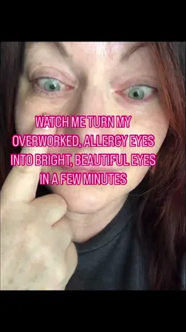 Watch my eyes go from TIRED to BRIGHT.   #hoodedlids @upneeq @patchology #ptosis #skincaretips #creatorinsights #swiftie