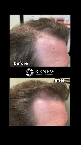 Not just a glow-up… it’s a total glow-OVER 💫 #renewoklahoma #aesthetics #transformation #cosmetics #plasticsurgery 