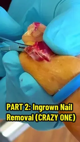 Part 2 of this PAINFUL INGROWN removal wait for the satisfying ending ✅ #ingrowntoenail #podiatry #satisfyingvideo #nail #transformation 