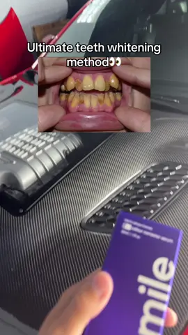 Teeth whitening has never been so easy #tiktokshopcreatorpicks #fyp #teeth #teethwhitening 
