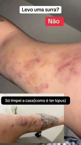 #lupuswarrior #lupus #rotina #casa 