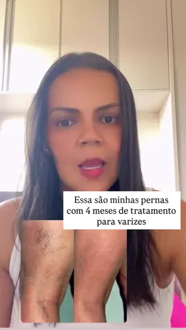 Com 4 meses de tratamento olha  a diferença…não é apenas estética, varizes é coisa séria.. . #varizes #varizessemcirurgia #varizesnuncamais #varizesevasinhos #mulheres 