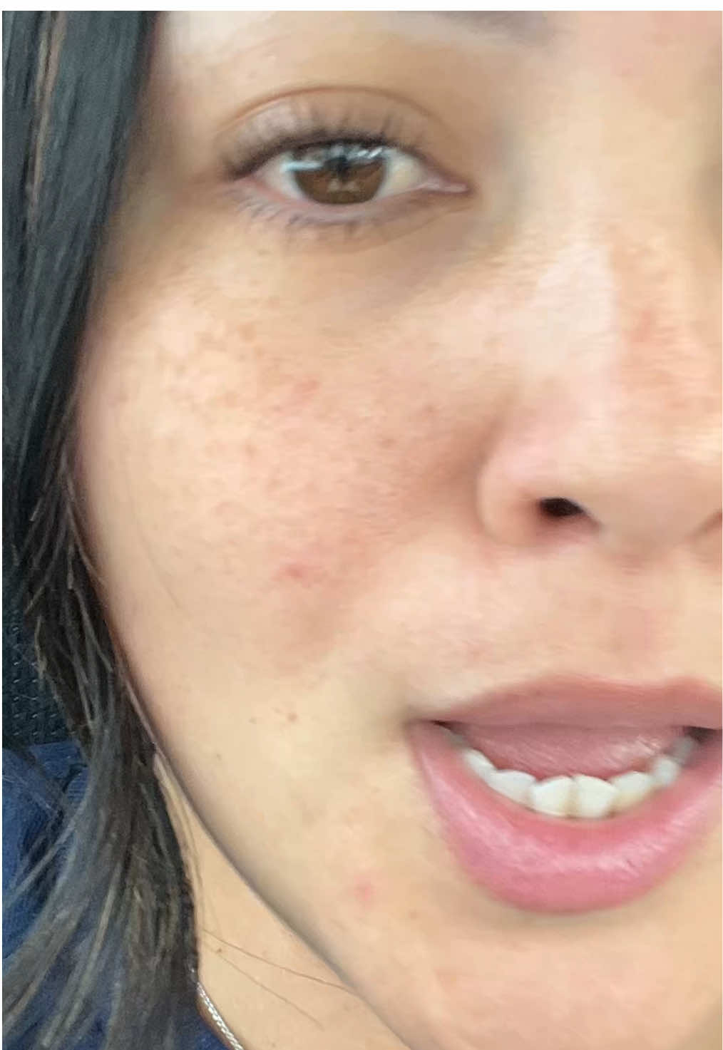 hormonal acne is the worst! #acne #hormones #blackhead 