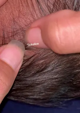 #tiktokindia_ #removalice #lice #omg 
