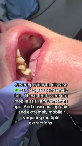 🦷🚨 Severe Gum Disease Alert! 🚨🦷 Most people think cavities are the #1 threat to teeth… but in adults, the biggest reason for tooth loss is actually periodontal (gum) disease. 👉 Periodontal disease happens when plaque and tartar build up under the gums, causing infection. Over time, this destroys the bone that holds your teeth in place. ⚠️ In the severe stage (advanced periodontitis), you’ll notice: 	•	Gums that are red, swollen, or bleeding easily 	•	Receding gums (teeth look longer) 	•	Loose or shifting teeth 	•	Bad breath that doesn’t go away 	•	Pain when chewing 	•	Pus between gums and teeth If untreated, teeth can literally fall out—even if they don’t have cavities. 💡 Treatment depends on severity: 	•	Deep cleanings (scaling & root planing) to remove infection below the gums 	•	Surgery or gum grafts in advanced cases 	•	Sometimes extractions + implants or dentures if teeth can’t be saved 🫀 Did you know gum disease is also linked to heart disease, diabetes, and even Alzheimer’s? Oral health = overall health. ✨ Prevention is powerful: 	•	Brush 2x daily 	•	Floss (yes, it matters!) 	•	Regular dental checkups & cleanings 	•	Don’t ignore bleeding gums—it’s NOT normal Remember: Healthy gums = strong foundation for your smile. Don’t wait until it’s too late.
