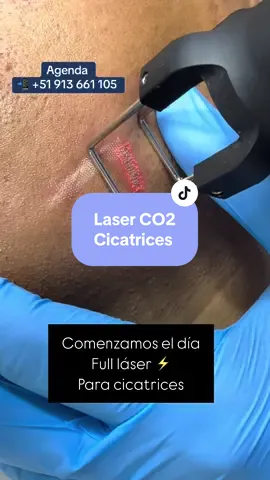 Láser para cicatriz #dermatologo #dermatologia #laser #cicatriz #co2 #marca #cicatrices #scar #crema #derm #piel #doctor #medicina 