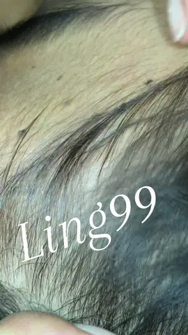 Remove lice #omg😘😘😘😍😍😻😻😽😽🥳🥳😂😂😂 #liceremoval #lice 
