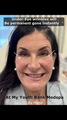 ✨ No Botox 💉 No Fillers 💋 No Surgery 🛑 Gianna’s PERMANENT + INSTANT lower-eyelid tightening 👀✨ We used the Agnes RF ⚡ — a next-gen device trusted by clinical trainers (aka the pros who teach other pros). It’s super skill-dependent — just like surgery or fillers, it’s all about the artistry of your provider 🎨💎. 👉 Always ask for before & afters if someone offers this treatment — results speak louder than words. 📽️ Watch until the end to see her 1-week transformation 🔥 You’ll be obsessed! #eyebags #darkcircles #MyYouthBankMedSpa #EyeRejuvenation #viral 