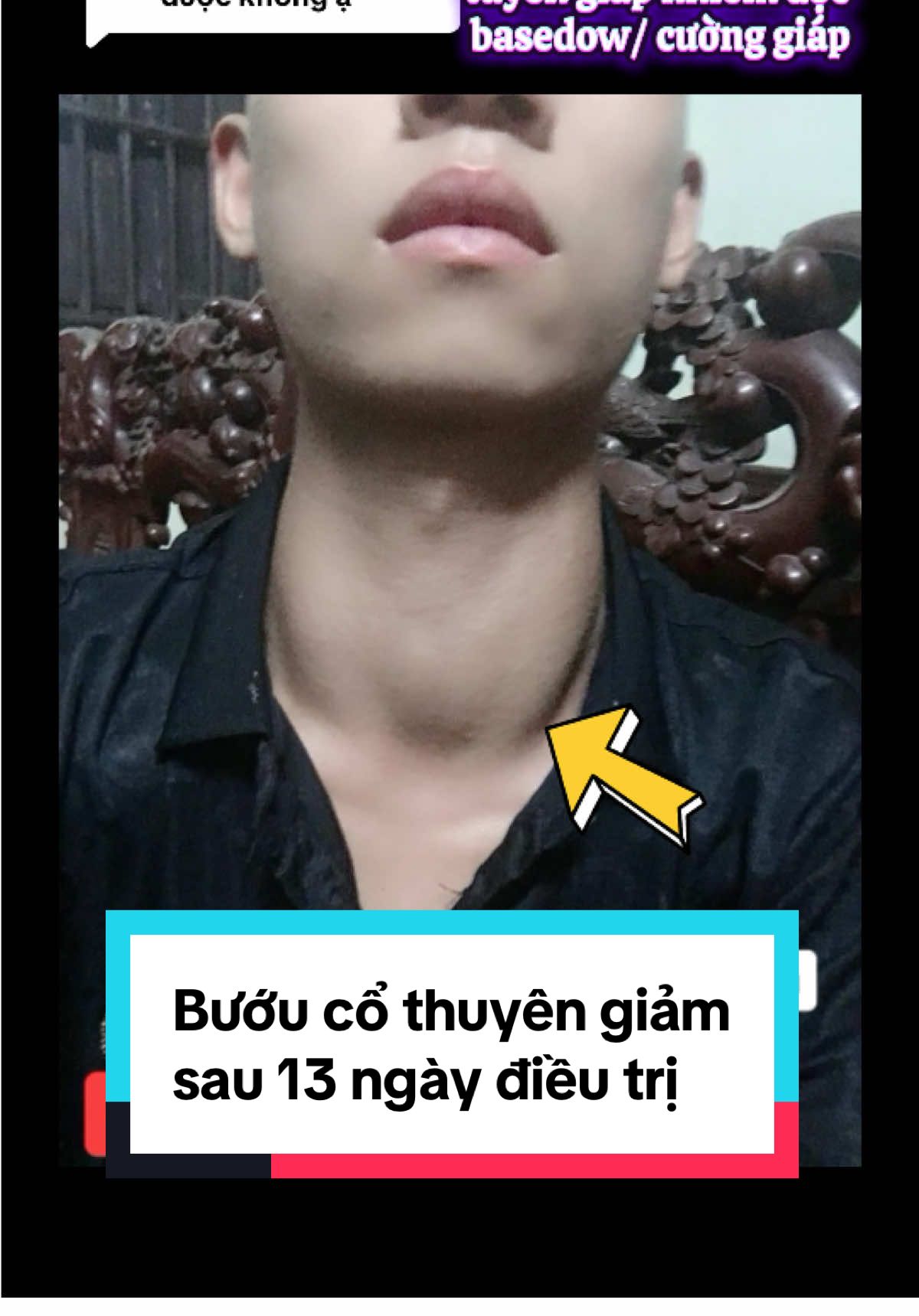 Trả lời @Bàn Ghến Phản hồi của bạn Minh Tuấn- Điều trị phình giáp do tuyến giáp nhiễm độc/ basedow #bướucổcườnggiáp 