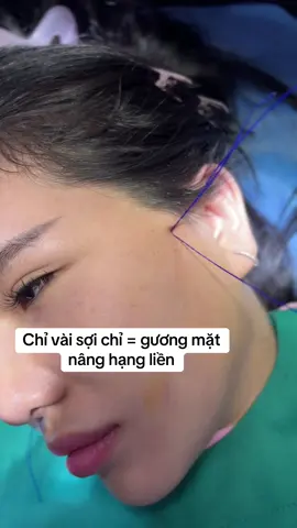 #CăngChỉNângCơ #TrẻHoáDa #KimBeauty #CăngDaKhôngDaoKéo #ChỉCollagen 