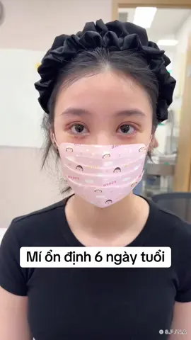 Hôm nay lại ra một siêu phẩm mí sau cắt chỉ 6 ngày 🥰#mí #drtuananhalikekorea #operasihidungvietnam #xuhuong 