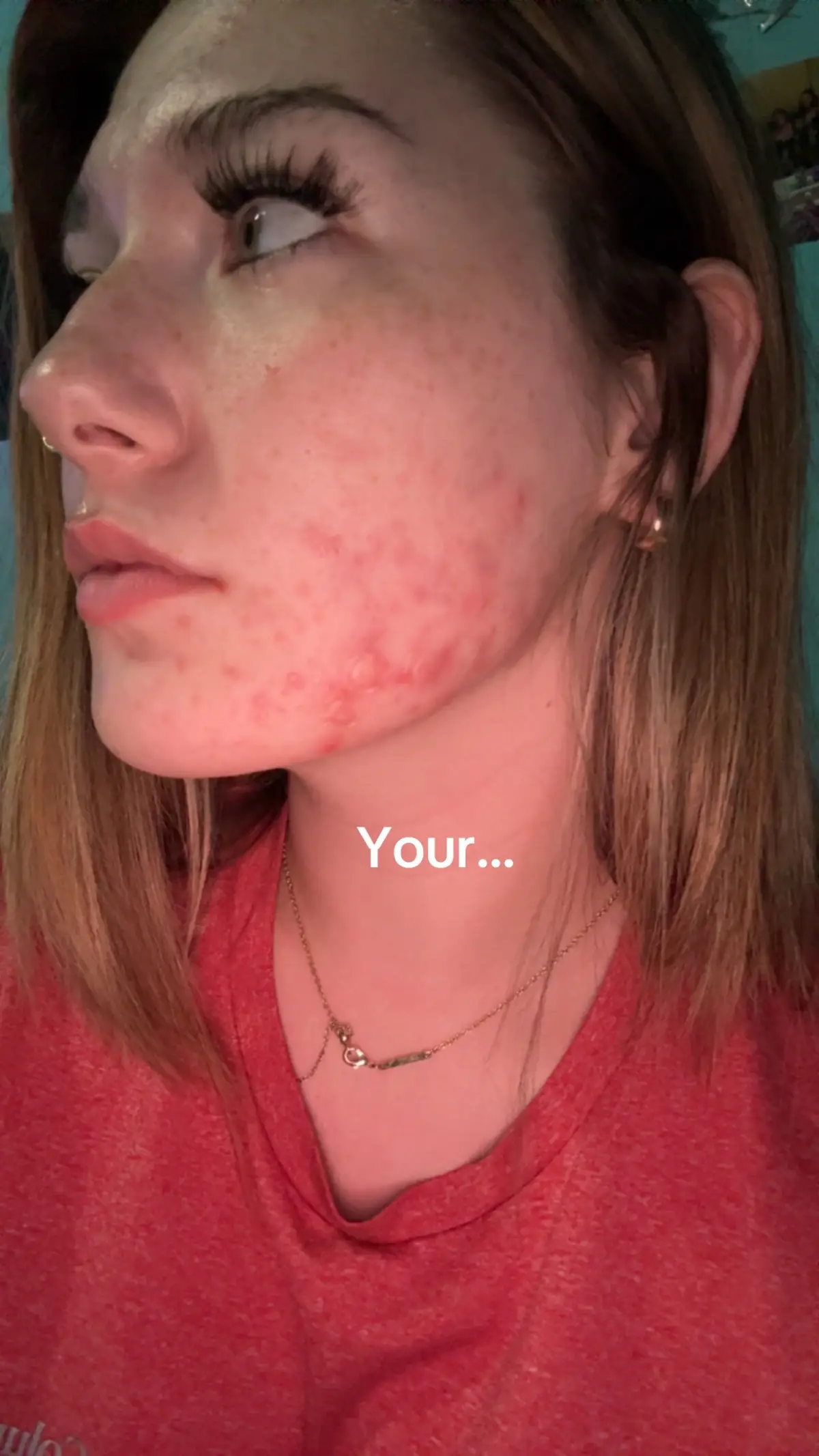 Inspired by @kate @Kate Baker🩷🩷 #acne #skin #blowup #viral #loveyourinsecurities 