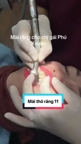 Mài răng cho chị gái Phú Xuyên - Hà Nội