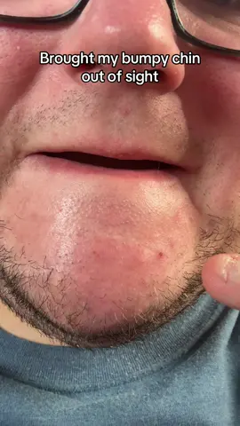 This peel shot does wonders for bumpy chins! #peelshot #drmelaxin #skincare #skincaretok #tiktokshopcreatorpicks 