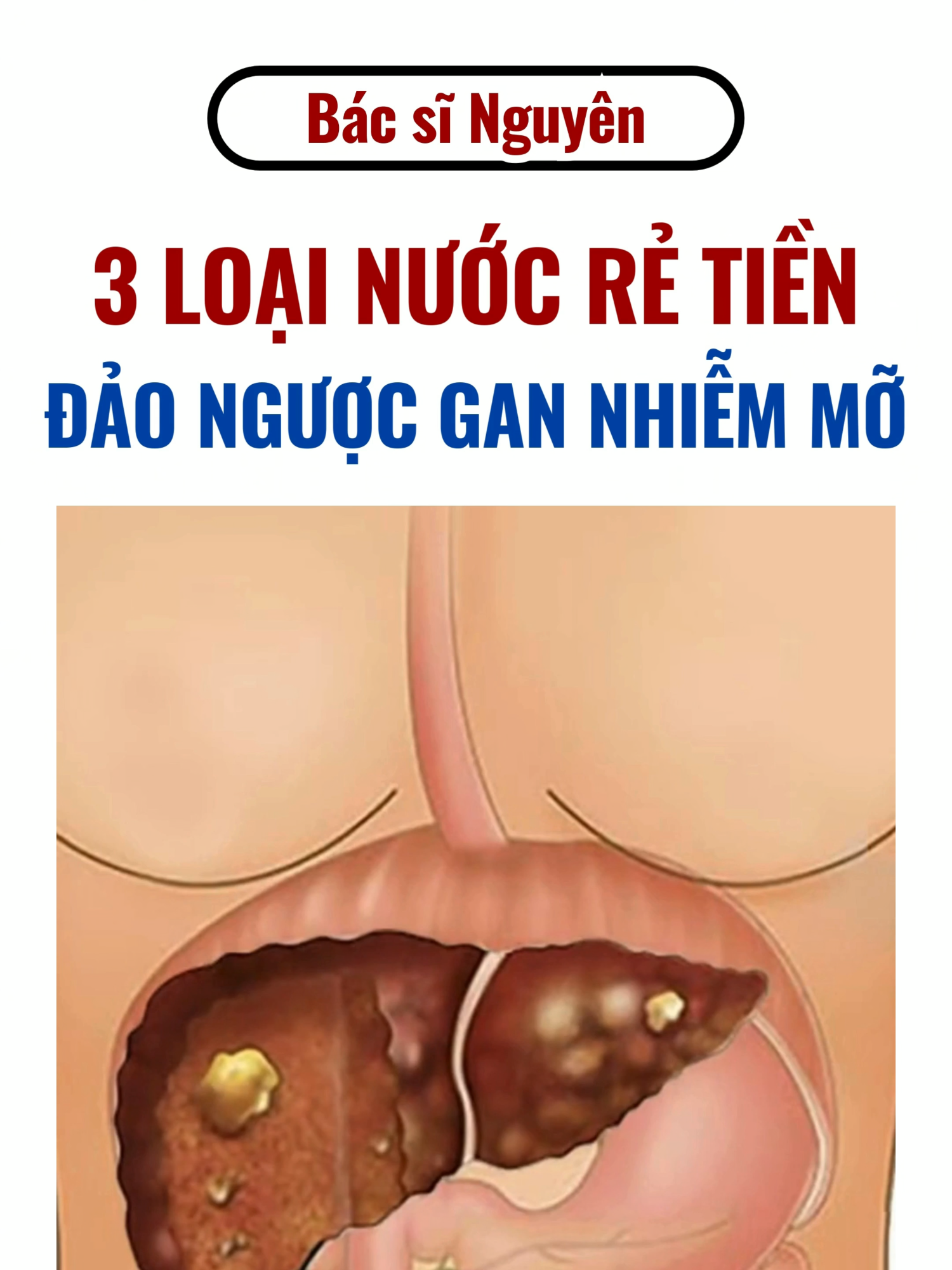 3 loại nước rẻ tiền giúp đảo ngược gan nhiễm mỡ !  #bsnguyen #bacsinguyen #xuhuong