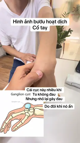 Hình ảnh bướu hoạt dịch Cổ tay #bướuhoạtdịch #buouhoatdich #yhocthethao #bacsicoxuongkhop #bacsicoxuongkhop #bacsichanthuongchinhhinh #nguyenviettan #chanthuongthethao #gut @Bs Tân thích khám khớp Vai 
