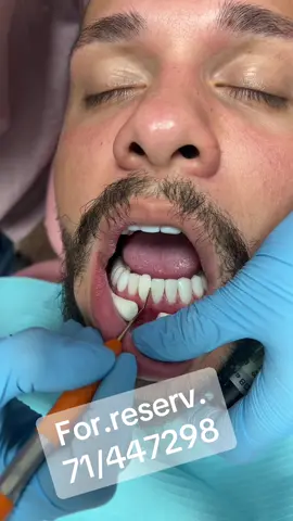 #compositeveneers #explorepage #luxurysmile #lebanontiktok #dental 