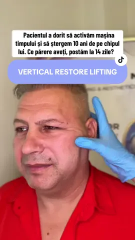 Vertical Restore Lifting cu o dorință de a da inapoi 10 ani, ce părere aveti? Am reușit? #facelift #browlift #liftingfacial #necklift #blefaroplastia 