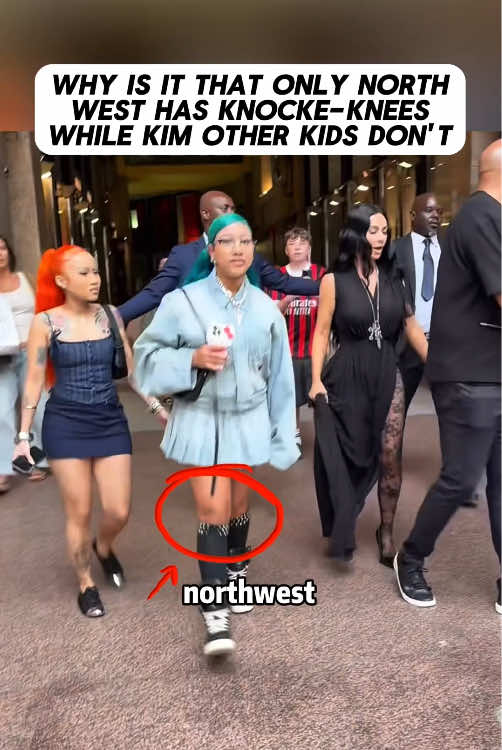 Why is it that only North West has knock-knees, while Kim’s other kids don’t#northwest#KimKardashian