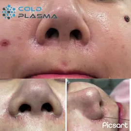 TRẢ KẾT QUẢ CẢ ĐIỀU TRỊ SẸO CÁNH MŨI SAU DUY NHẤT 1 BUỔI #ColdPlasma #Coldplasmahanoi #coldplasmavietnam #SeoPhauThuat 