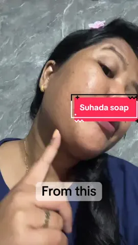 Higly recomended💯#foryoupage #viralproducts #suhada #melasmatreatment 