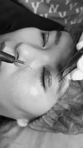 Loại bỏ mỡ dư vùng mắt #sửamí #cấymotuthan #cắtminideep 
