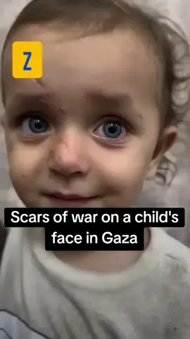 Scars of war on a child's face in Gaza. #gazachildren  #gazawar  #palestine  #Israel  #gaza 