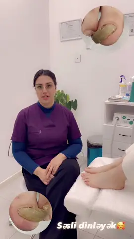 🎥 *Hipertrofik (qalınlaşmış) dırnaq nədir?* Bu videoda gördüyünüz dırnaq *hipertrofik dırnaq*dır – qalın, sərt və çox vaxt ağrılı olur. 👣 📌 Bu vəziyyətin əsas səbəbləri: – Uzunmüddətli təzyiq və travmalar  – Göbələk infeksiyaları  – Genetik faktorlar  – Yanlış dırnaq baxımı və ya ayaqqabı seçimi 💡 *Nə etməli?* Bu cür dırnaqlar ev şəraitində kəsilməməlidir! Çünki infeksiya riski və daha ciddi deformasiyalar yarana bilər. 👩‍⚕️ Podoloji baxım zamanı: ✅ Dırnaq peşəkar cihazlarla nazikləşdirilir  ✅ Təmizləmə və dezinfeksiya edilir  ✅ Lazım olarsa, əlavə müalicə planlanır 🦶 Dırnaq sağlamlığına biganə yanaşmayın. Vaxtında edilən müdaxilə ilə həm ağrılardan, həm də estetik narahatlıqlardan azad olun. 📍 Siz də oxşar problemdən əziyyət çəkirsinizsə, bizimlə əlaqə saxlayın. 📞 055 447 47 68  📍İstanbul ns klinika \ Foothealth  #hipertrofikdırnaq #podologiya #dırnaqproblemi #ayaqsağlamlığı #podoloqbakısı   