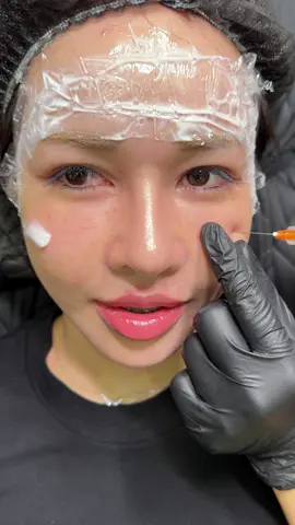 Làm đầy trũng mắt bằng tinh chất Royal siêu êm ☺️#filler #xuhuongtiktok #xuhuong2025 #haiphong #xuhuong 