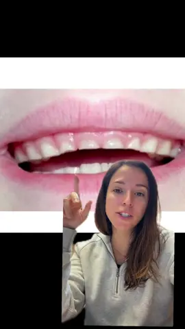 #greenscreen  flat worn down baby teeth can be one of the first signs of airway issues. Let’s talk about it #orthodontist #nasalbreathing 