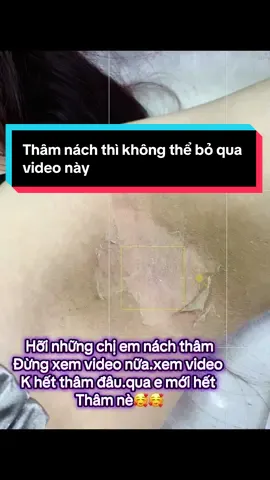 Nách thâm bẩm sinh,thâm sau sinh,thâm do cháy peêl...qua em giải quyết trong 20p#kimchibeauty #kimchibắcninh #dượcmypham #đàotaohocvien #thâmnách