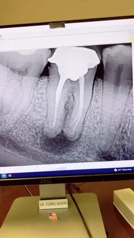 Why do some root canals fail? #dentists #rootcanal #dentistry #dentalstudent #dentalhygienist 