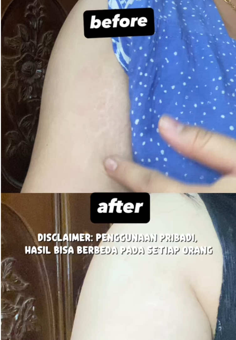 gaperlu malu lagi deh kalo mau pake baju ala ala gen Z 😜  #strechmarks #strechmark #strechmarkserum #strechmarkoil #ciaraindonesia 