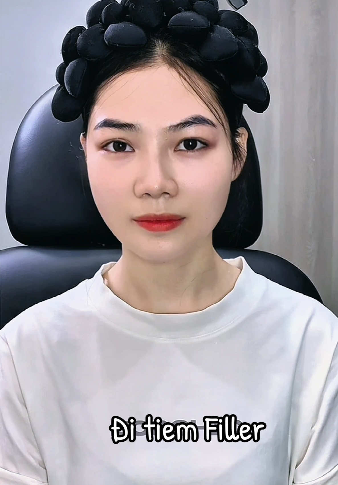 Sau khi tiêm Filler sẽ như thế nào ? @Hương Filler ♥️ 