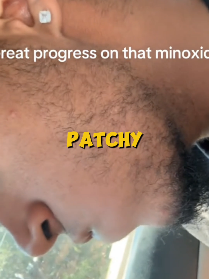 Get rid of patchy beard using these methods. Search 