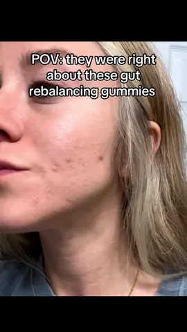 Healing your gut really does fix your skin #acnetreatment #acneskincare #acnejourney 
