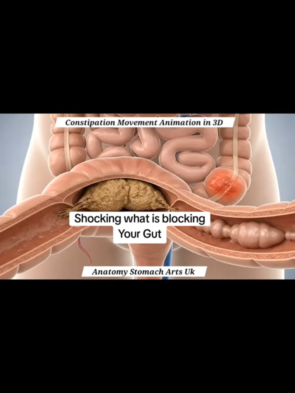 What Happens If You Don’t Poop for 7 Days 🚫💩 | Explore Digestive journey, human body animation, anatomy crash course, ai-generated, us biology education “medical animation” “pre med study” “nursing school anatomy” “MCAT biology” “U.S. healthcare system” “AI-generated anatomy Disclaimer:The content on Anatomy AI Arts is created for educational, informational, and entertainment purposes only. All images, animations, and videos are generated using AI tools and should not be interpreted as professional medical advice, diagnosis, or treatment. For any medical concerns, always seek guidance from a qualified healthcare provider. While we aim for accuracy, AI-generated content may contain errors, artistic interpretations, or simplifications   #ConstipationRelief #BlockedColon #LeakyGut #HealthTips #WellnessTok   