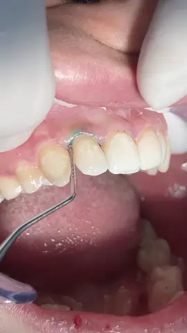 Composite restoration for anterior teeth #dentist #dental #dentistry 