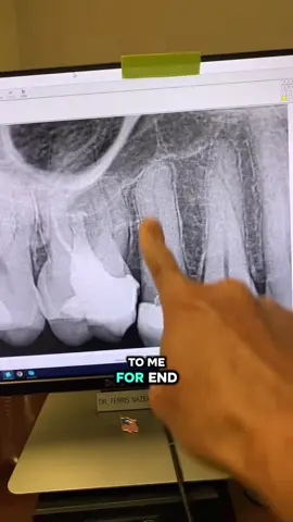 Check out tooth #3! Why do you think such a root canal has remained successful for many years? Where’s the apical seals? What about extend of obturation?! Does extend of obturation matter? #dentists #rootcanal #dentistry #dentalstudent 