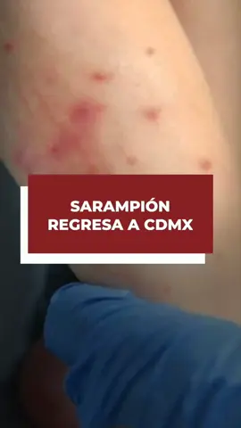 En 2025 el sarampión regresa: en CDMX, 3 alcaldías con contagios y hospitales sin vacunas. Familias reciben la misma respuesta: “no hay dosis, apúntese en la lista”. El virus es letal, pero la negligencia lo es más. Todo lo dicho en el video representa únicamente una opinión personal.