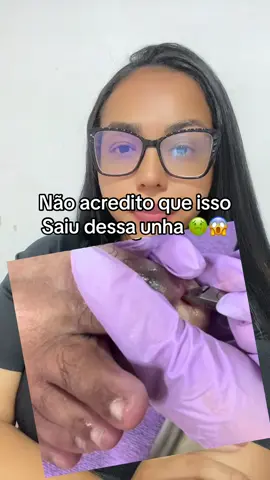 Manicure / podóloga  #unha #unhaencravada #podologia #react #foryou 