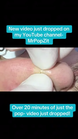 20 minutes of just the pop just dropped on my YouTube channel-MrPopZit! Come check it out! #dermatology #mrpopzit #mpzdermatology #blackhead #extractions 