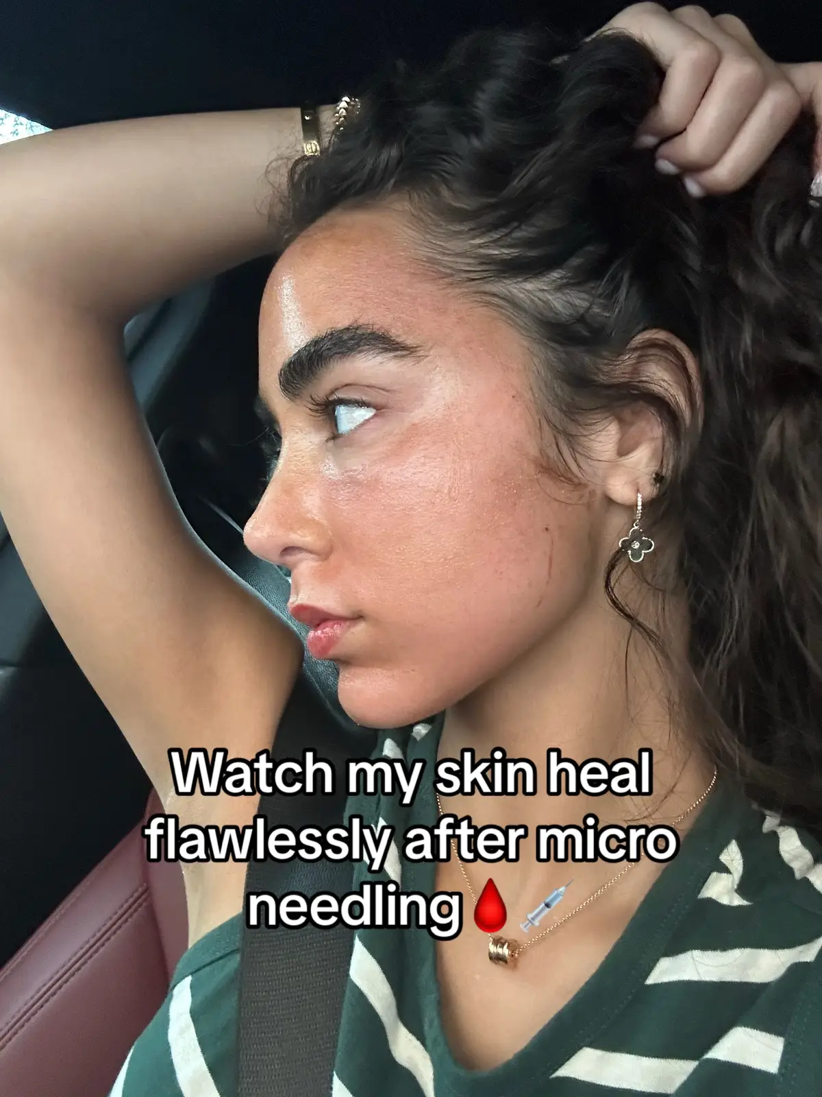 #microneedling 