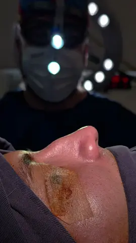 Rinoplastia Colombia 👃  . #rhinoplasty #plasticsurgery #beauty #drluispedroza 
