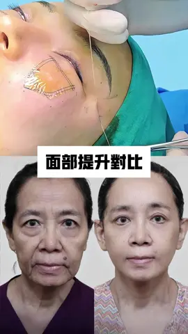 諮詢line：say0099 #法令紋改善 #臉部提升  #幼態臉#輪廓固定#Face lift