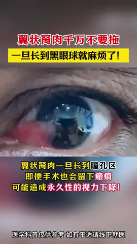 翼状胬肉千万不要拖 #翼状胬肉  #视力健康