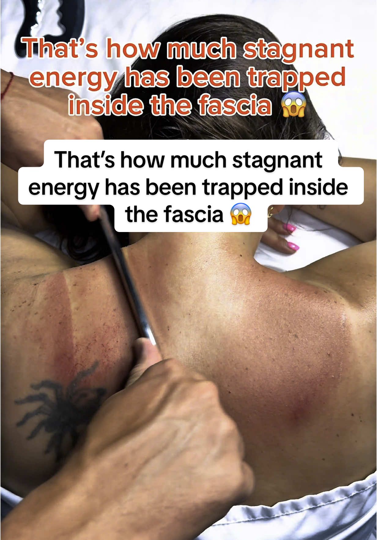 That’s how much stagnant energy has been trapped inside the fascia 😱 When fascia gets blocked, it creates pain, stiffness, inflammation & fatigue all through the body. Releasing it with the right techniques = instant freedom & flow 🔥✨ #fasciarelease #kinesiomassage #stagnantenergy #painrelief #guaSha #backpainrelief #myofascialrelease #healingenergy #bodyhealing #deepmassage #kinesiology